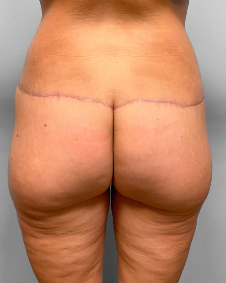 After Image: Butt Lift- Dr. Howell - front