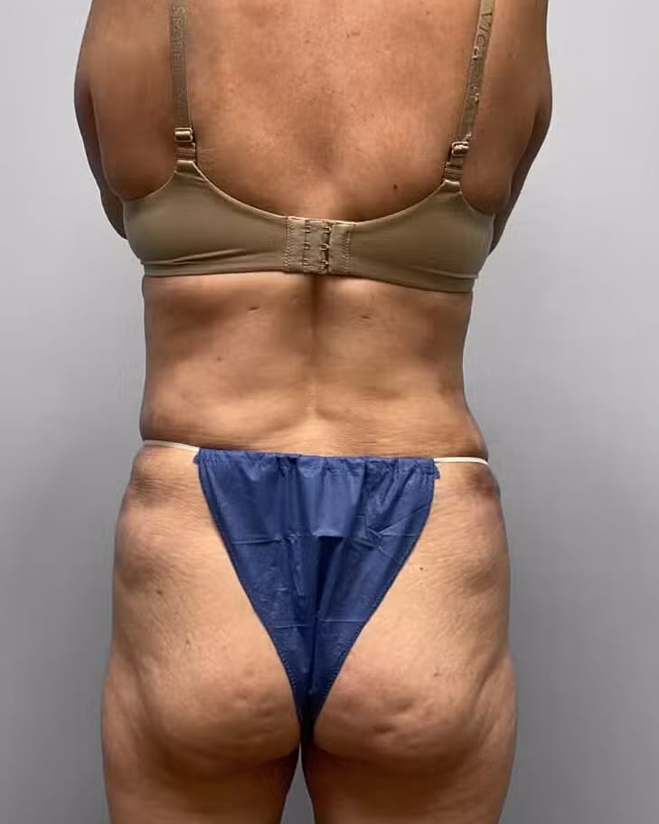 After Image: Tummy Tuck, Lipo, & BBL – Dr. Tucker - back
