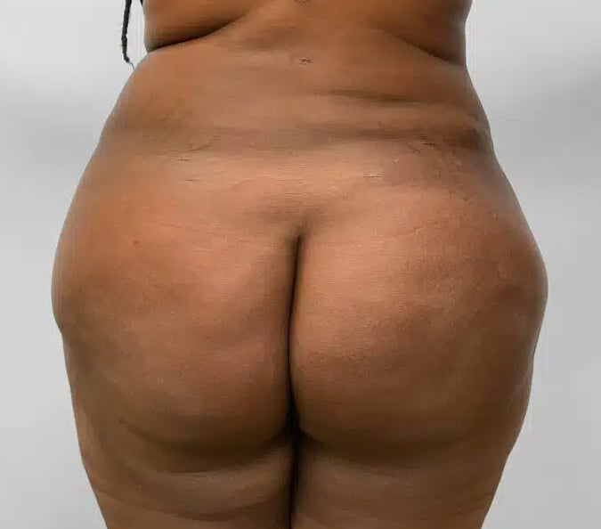 After Image: BBL Fat Transfer- Dr. Tucker - back