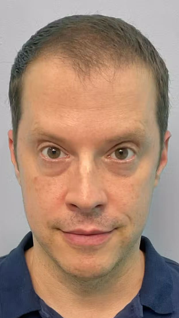 After Image: Botox- Joy - front