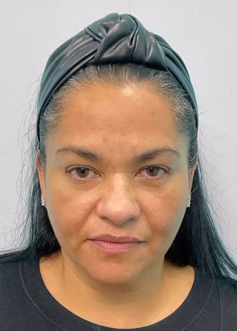 After Image: Botox & Juvéderm- Joy - front