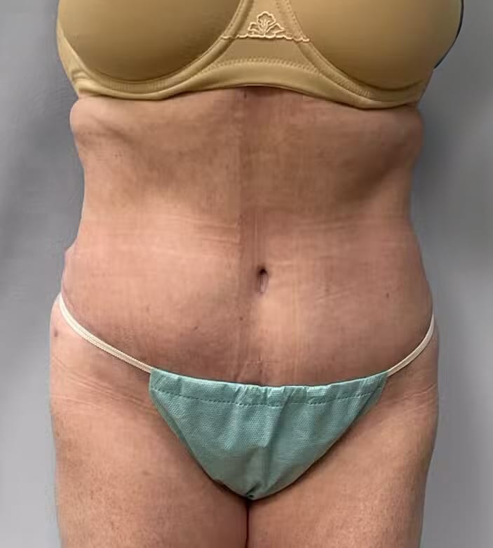 After Image: Abdominoplasty & Lipo – Dr.Howell - front