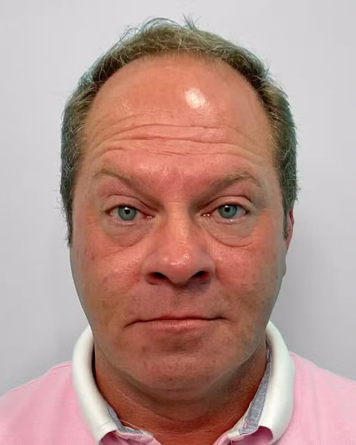After Image: Botox – Joy - front
