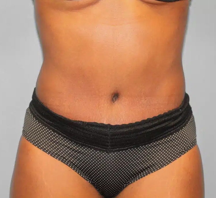 After Image: Abdominoplasty (Tummy Tuck) – Dr. Howell - front
