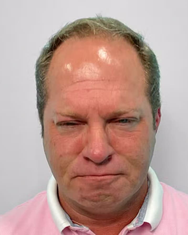 After Image: Botox – Joy - front