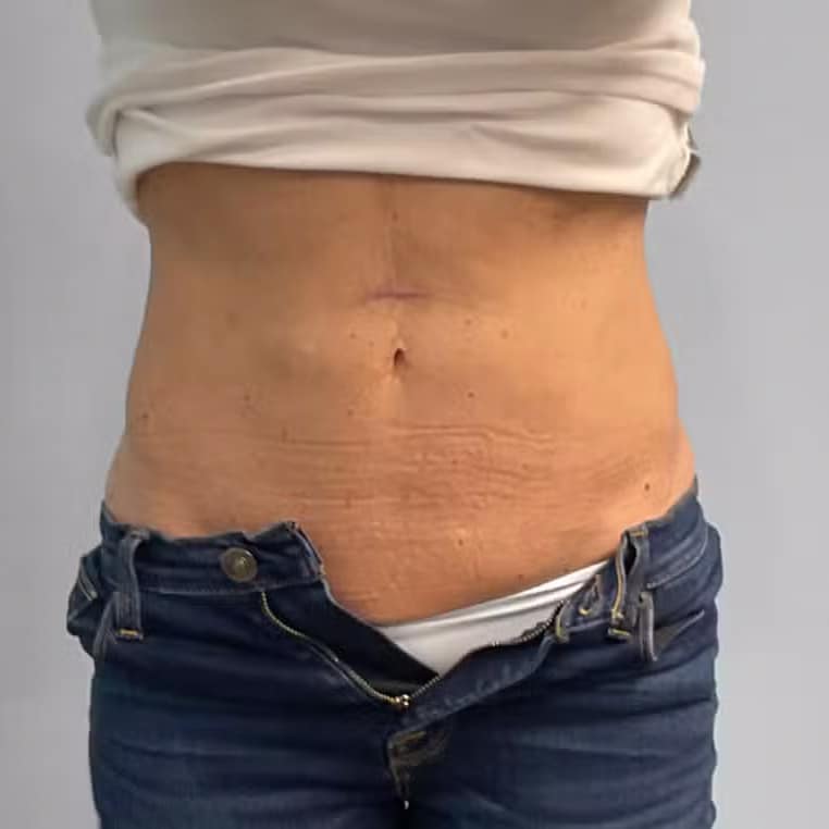 After Image: Coolsculpting- Jessica - front