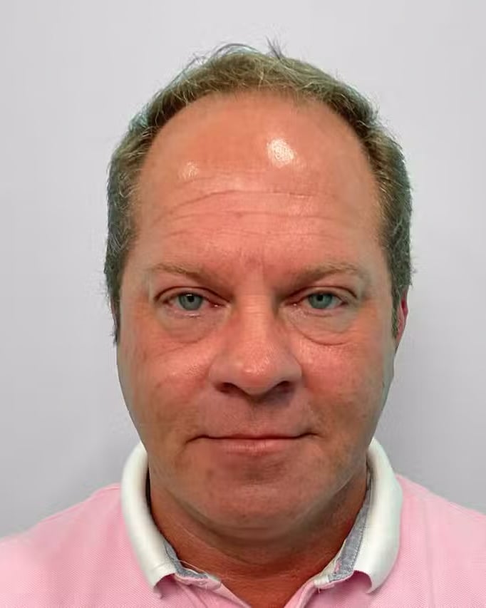 After Image: Botox – Joy - front