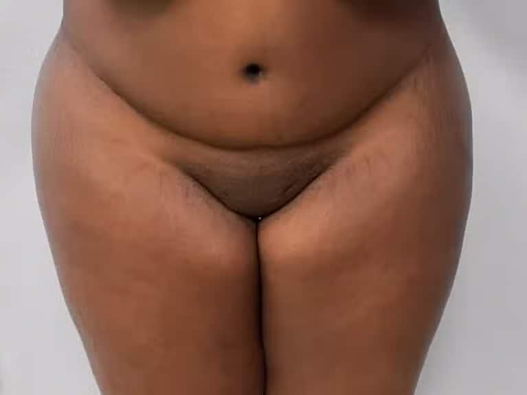 After Image: BBL Fat Transfer- Dr. Tucker - front