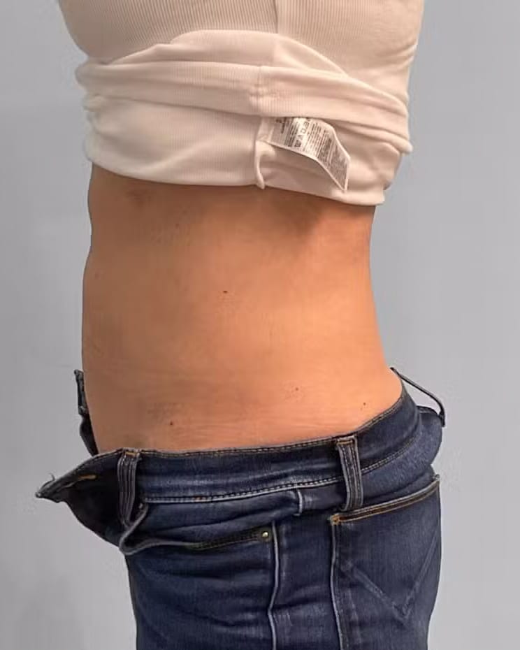 After Image: Coolsculpting- Jessica - left-side