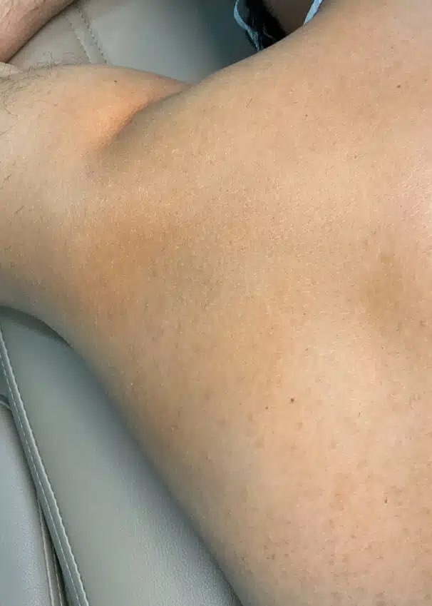After Image: Laser Hair Removal- Jade - left-side