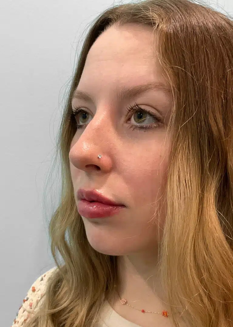 After Image: Juvéderm Ultra – Heather - left-front-oblique
