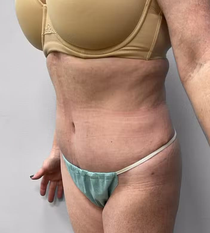 After Image: Abdominoplasty & Lipo – Dr.Howell - left-front-oblique
