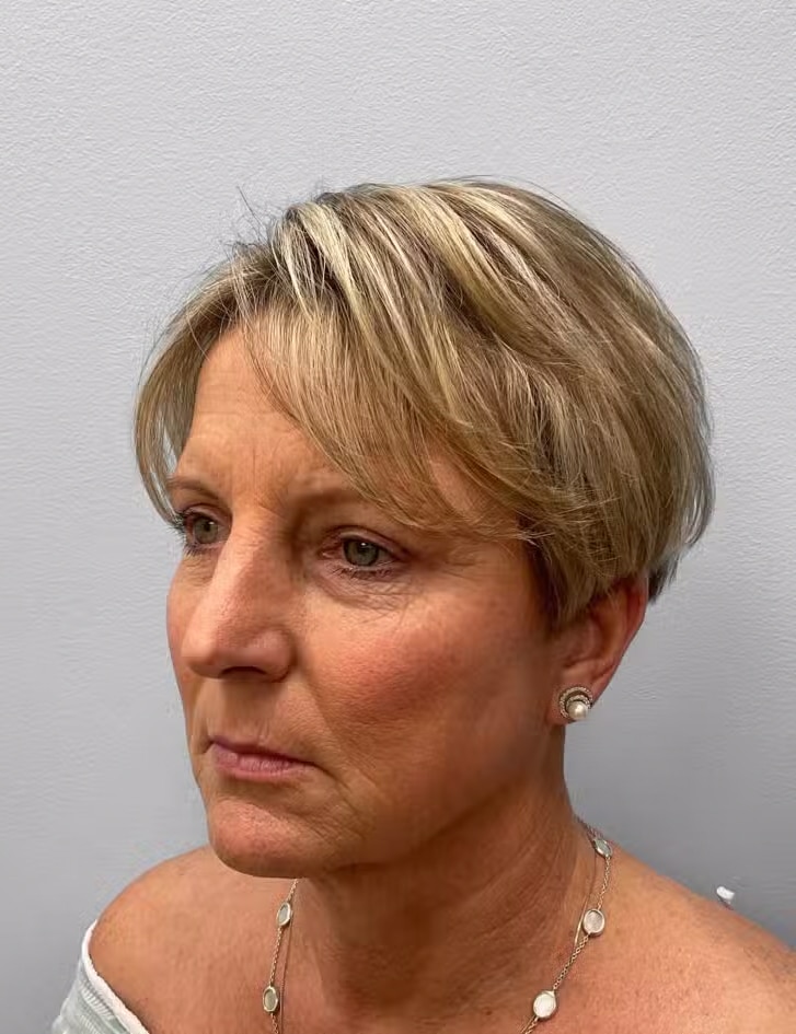 After Image: Blepharoplasty & Laser Resurfacing- Dr. Howell - left-front-oblique