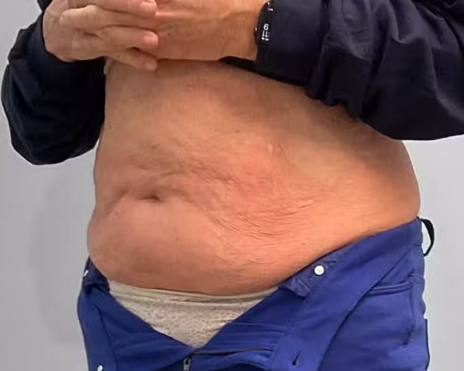 After Image: Emsculpt Neo- Jessica - left-front-oblique