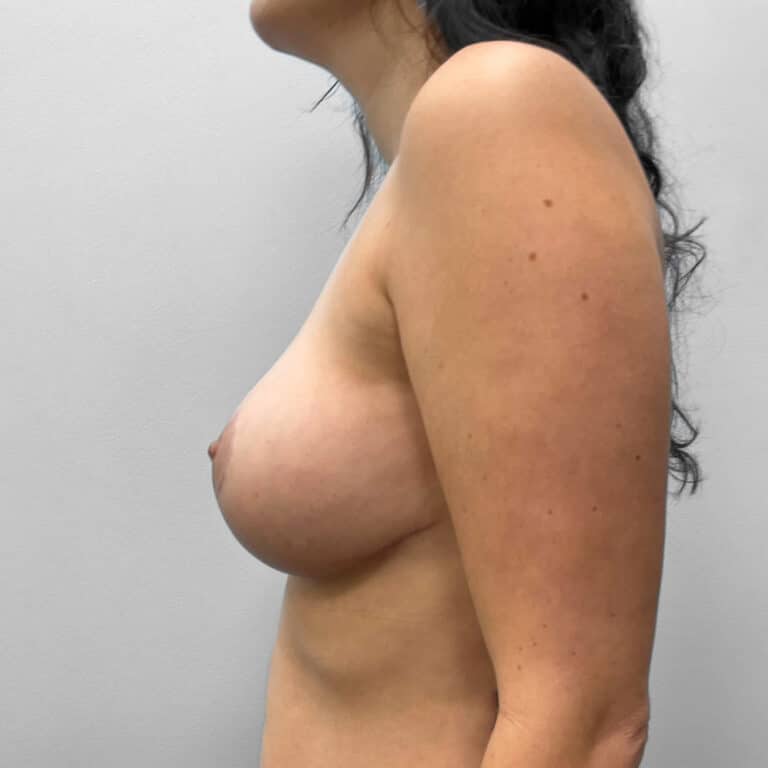 After Image: Breast Lift – Dr. Howell - left-side