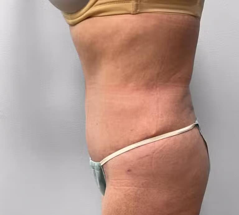 After Image: Abdominoplasty & Lipo – Dr.Howell - left-side
