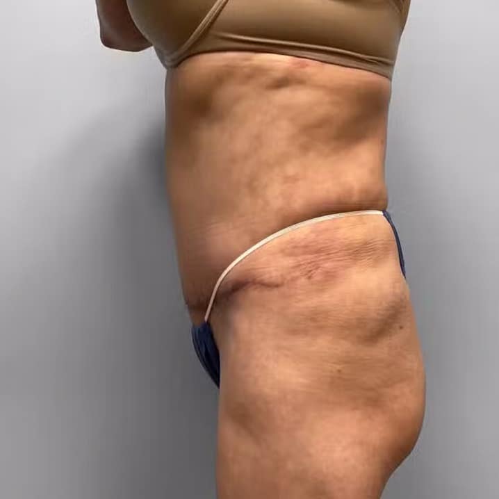 After Image: Tummy Tuck, Lipo, & BBL – Dr. Tucker - left-side