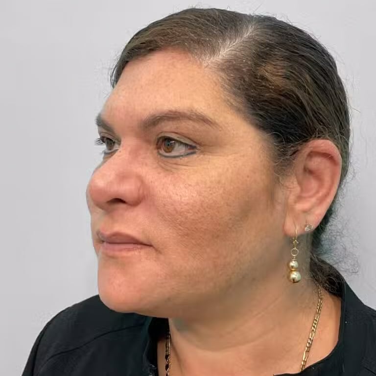 After Image: Kybella- Joy - left-front-oblique