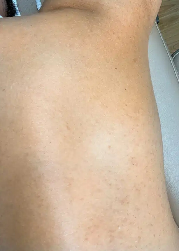 After Image: Laser Hair Removal- Jade - right-side