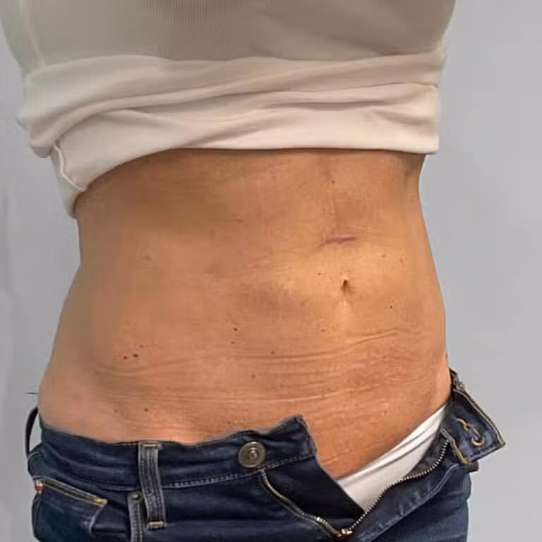 After Image: Coolsculpting- Jessica - right-front-oblique