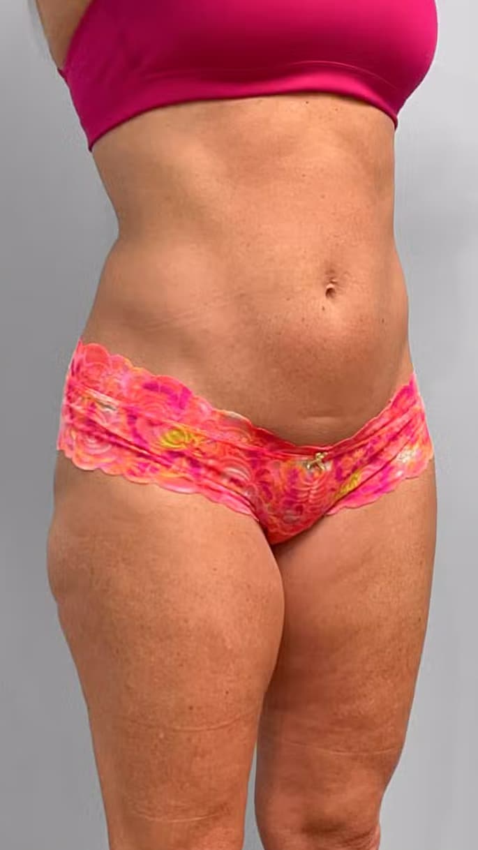 After Image: Emsculpt Neo- Jessica - right-front-oblique