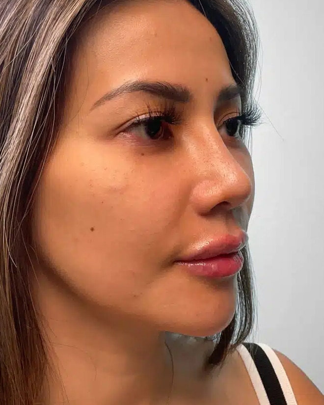 Before Image: Juvéderm Volbella & Botox – Heather - right-front-oblique