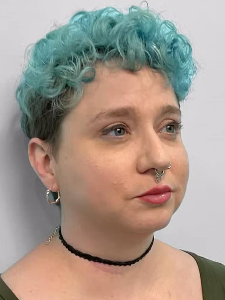 After Image: Restylane Kysse – Joy - right-front-oblique