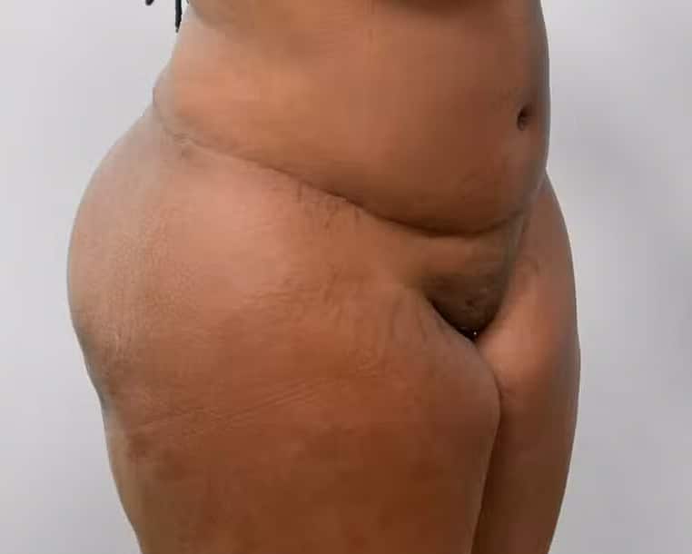 After Image: BBL Fat Transfer- Dr. Tucker - right-front-oblique