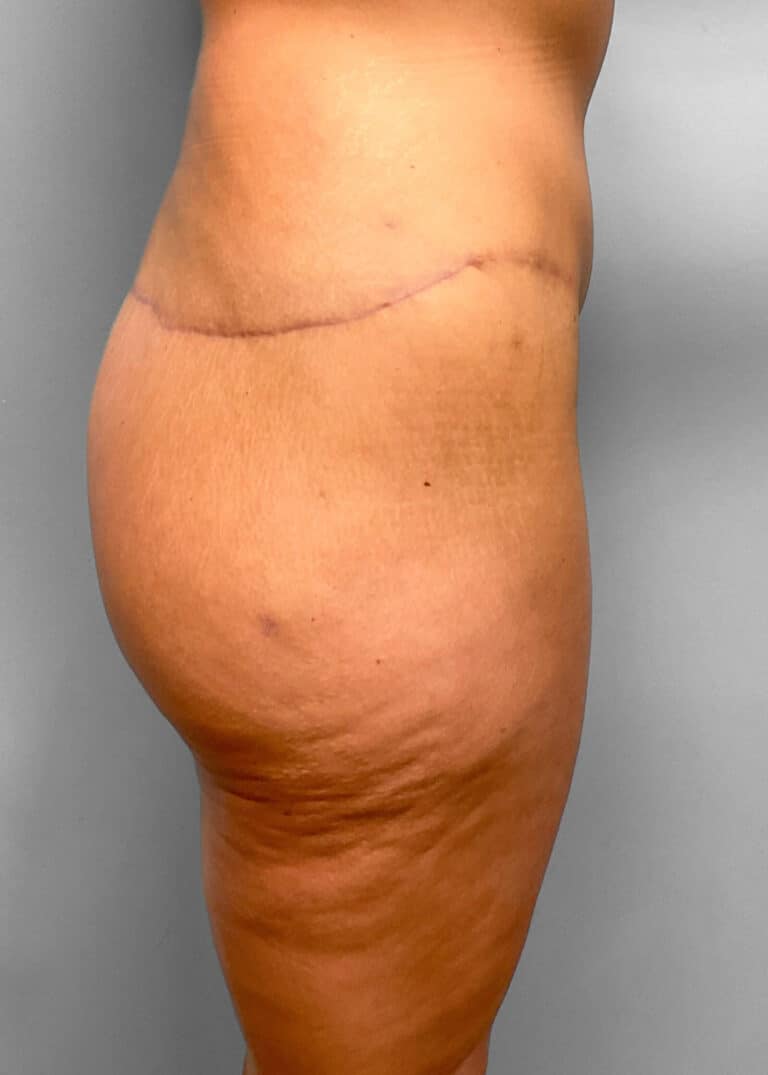 After Image: Butt Lift- Dr. Howell - right-side