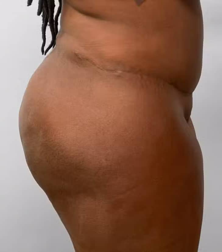 After Image: BBL Fat Transfer- Dr. Tucker - right-side