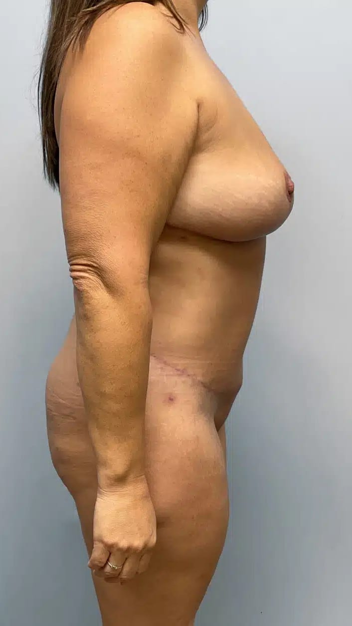 After Image: Mommy Makeover- Dr. Howell - right-side