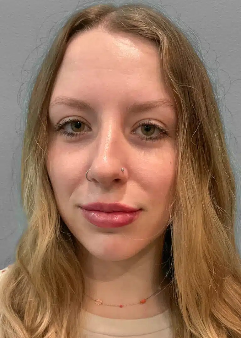 After Image: Juvéderm Ultra – Heather - front
