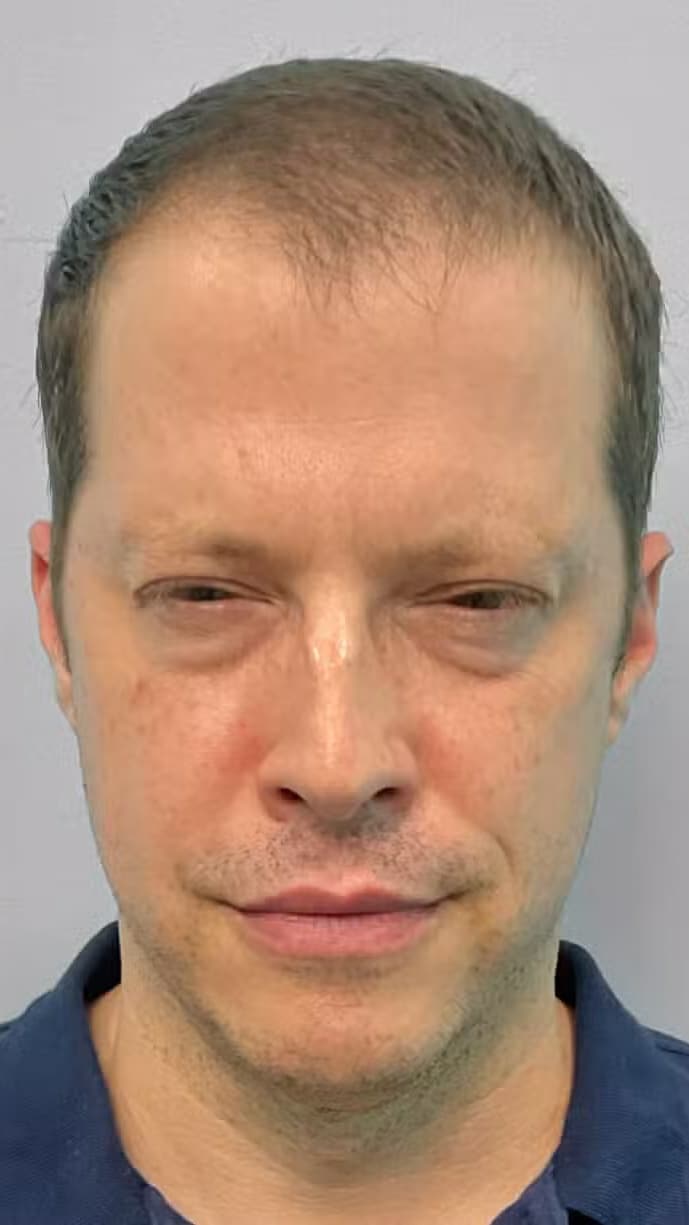 After Image: Botox- Joy - front