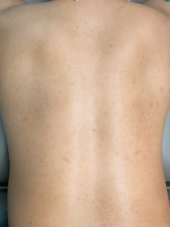 After Image: Laser Hair Removal- Jade - back