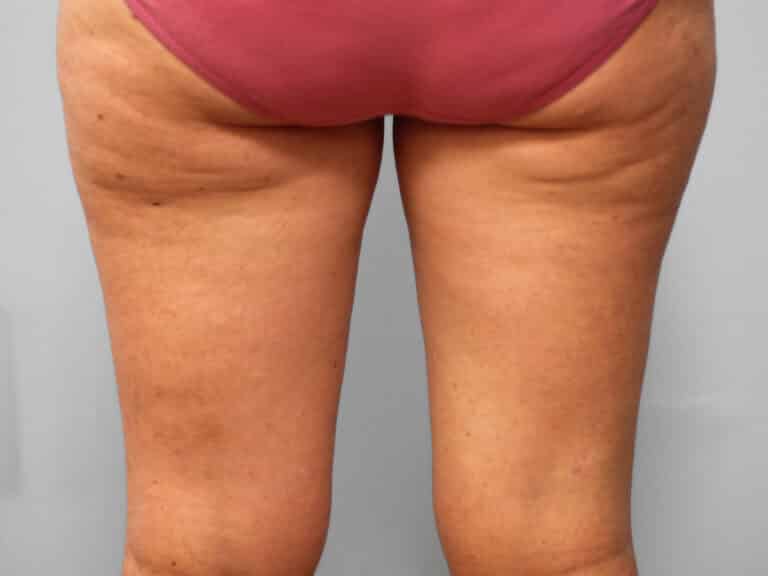 Before Image: Mommy Makeover – Dr. Tucker - back