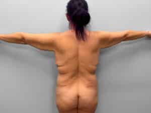 Before Image: Mommy Makeover – Dr. Tucker