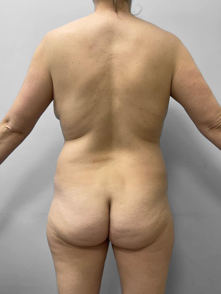 Before Image: Mommy Makeover – Dr. Tucker -