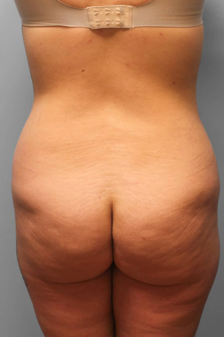 Before Image: Abdominoplasty – Dr. Howell - back