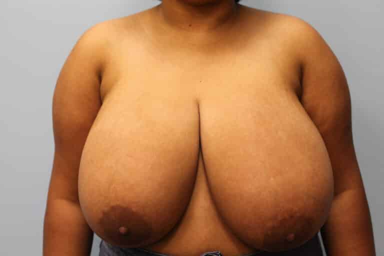Before Image: Breast Reduction – Dr. Howell - front