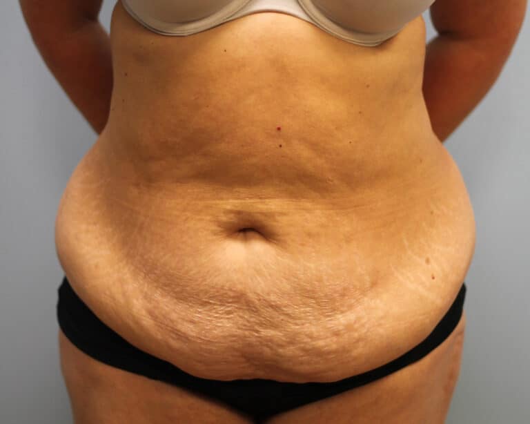 Before Image: Abdominoplasty – Dr. Tucker - front
