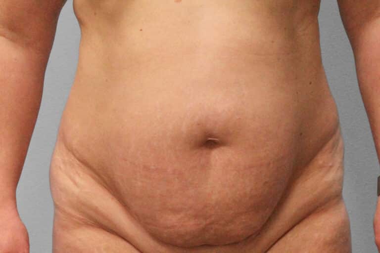 Before Image: Abdominoplasty (Tummy Tuck) – Dr. Tucker - front