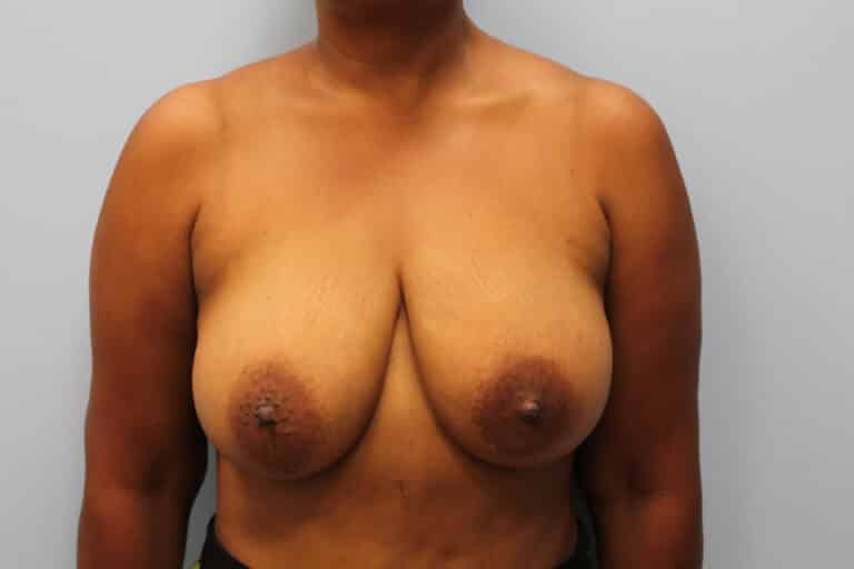 Before Image: Breast Reduction – Dr. Tucker - front