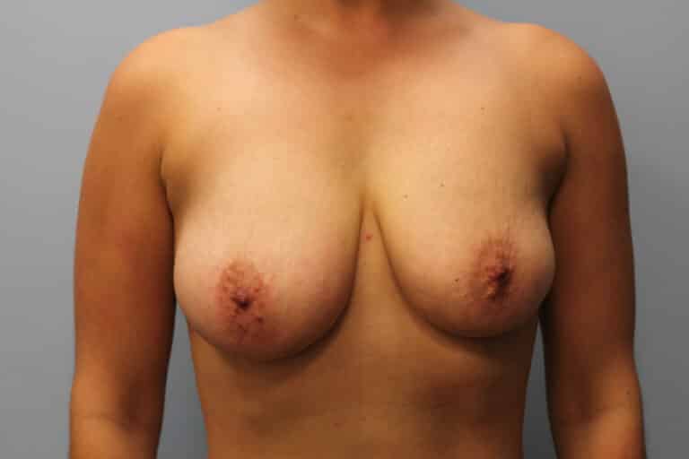 Before Image: Breast Augmentation & Lift- Dr. Howell - front