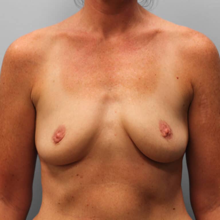 Before Image: Mommy Makeover – Dr. Tucker - front