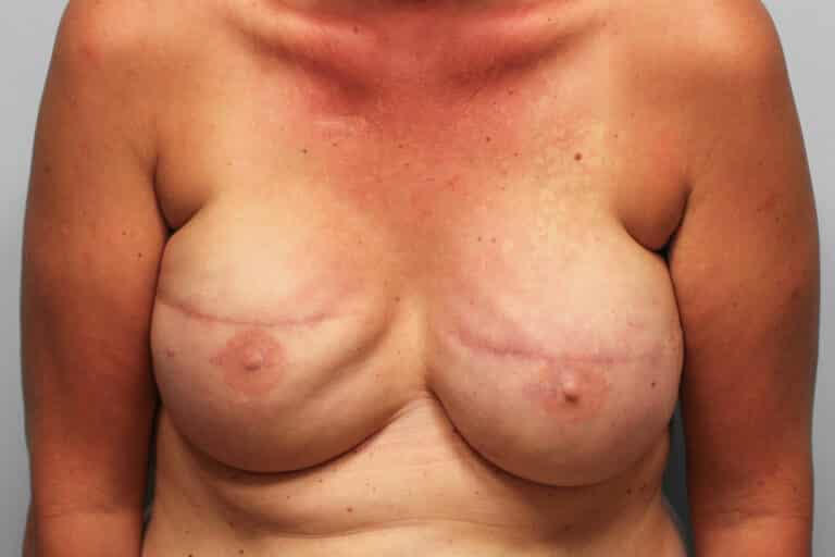Before Image: Breast Reconstruction – Dr. Tucker - front