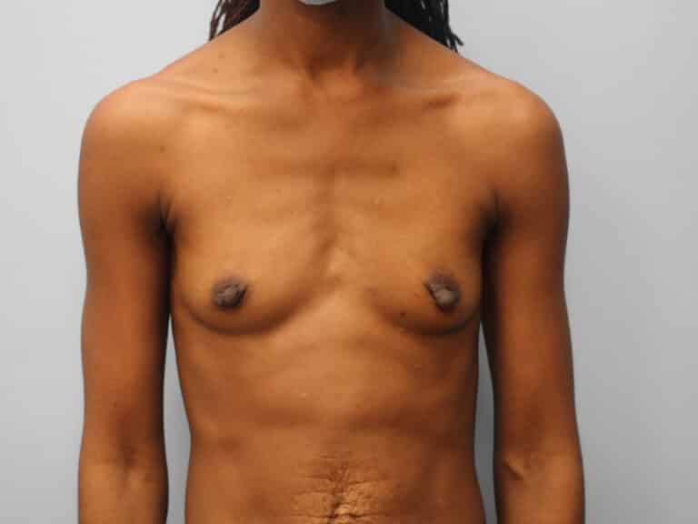 Before Image: Breast Augmentation – Dr. Tucker - front