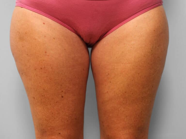 Before Image: Mommy Makeover – Dr. Tucker - front