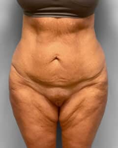 Before Image: Abdominoplasty & Thigh Lift – Dr. Tucker