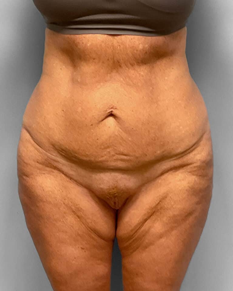 Before Image: Abdominoplasty & Thigh Lift – Dr. Tucker - front