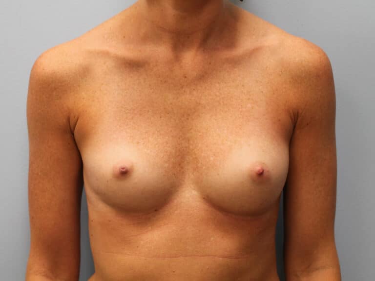 Before Image: Breast Augmentation- Dr. Tucker - front